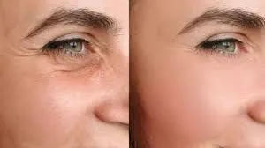 ✨ Tecnología de Precisión: La Nueva Era en el Tratamiento de Arrugas de Expresión